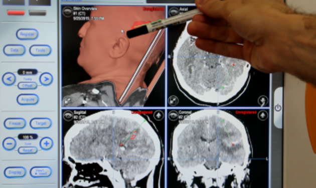 Гематому мозга впервые удалили без трепанации черепа в Дагестане