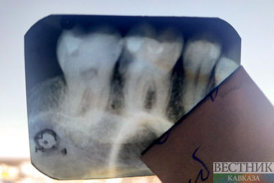 Зубной имплантат, опережающий импортные аналоги, придумали в Кабардино-Балкарии